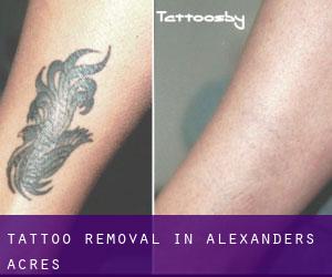 Tattoo Removal in Alexanders Acres