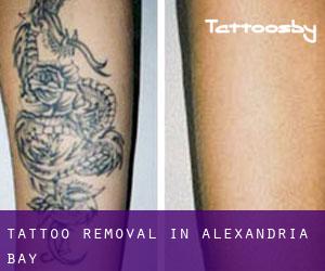 Tattoo Removal in Alexandria Bay