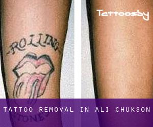 Tattoo Removal in Ali Chukson