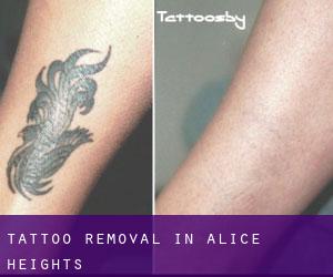 Tattoo Removal in Alice Heights