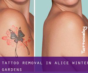Tattoo Removal in Alice Winter Gardens