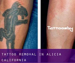 Tattoo Removal in Alicia (California)