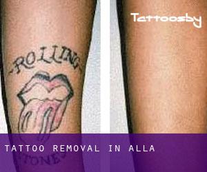 Tattoo Removal in Alla