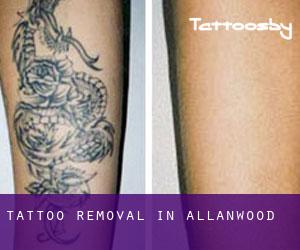 Tattoo Removal in Allanwood