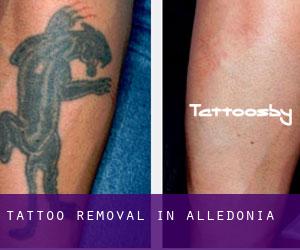 Tattoo Removal in Alledonia