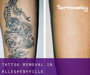 Tattoo Removal in Alleghenyville