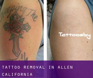 Tattoo Removal in Allen (California)