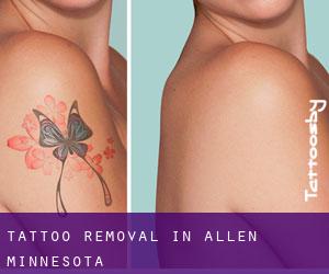 Tattoo Removal in Allen (Minnesota)