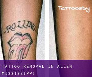 Tattoo Removal in Allen (Mississippi)