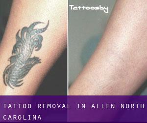 Tattoo Removal in Allen (North Carolina)
