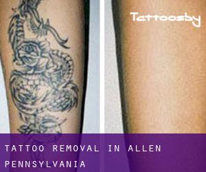Tattoo Removal in Allen (Pennsylvania)