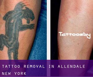 Tattoo Removal in Allendale (New York)