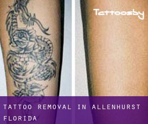 Tattoo Removal in Allenhurst (Florida)