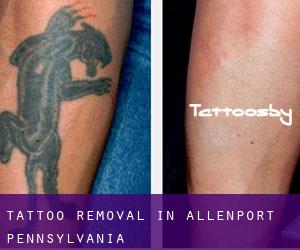 Tattoo Removal in Allenport (Pennsylvania)