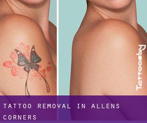 Tattoo Removal in Allens Corners