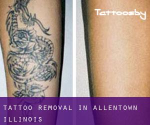Tattoo Removal in Allentown (Illinois)