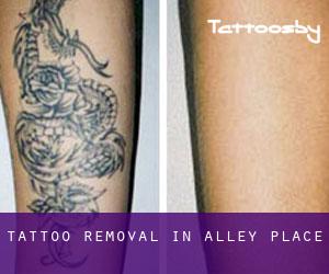 Tattoo Removal in Alley Place
