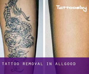Tattoo Removal in Allgood