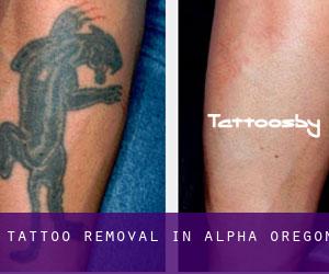 Tattoo Removal in Alpha (Oregon)