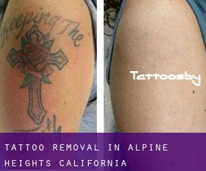 Tattoo Removal in Alpine Heights (California)