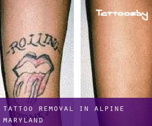 Tattoo Removal in Alpine (Maryland)
