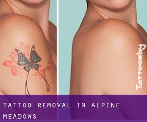 Tattoo Removal in Alpine Meadows