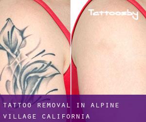 Tattoo Removal in Alpine Village (California)