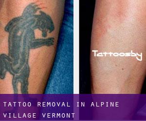 Tattoo Removal in Alpine Village (Vermont)