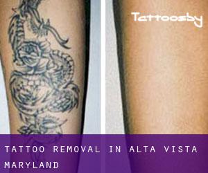 Tattoo Removal in Alta Vista (Maryland)
