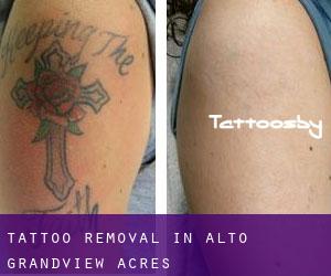 Tattoo Removal in Alto Grandview Acres