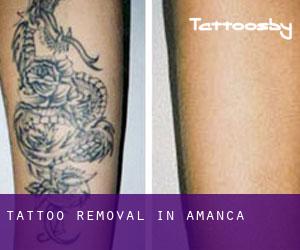 Tattoo Removal in Amanca