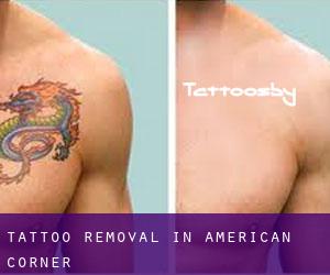 Tattoo Removal in American Corner