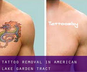 Tattoo Removal in American Lake Garden Tract