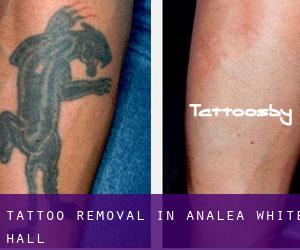 Tattoo Removal in Analea White Hall
