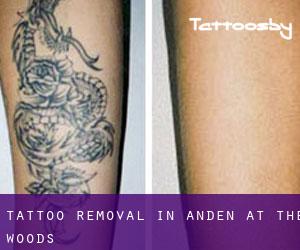 Tattoo Removal in Anden at the Woods