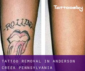 Tattoo Removal in Anderson Creek (Pennsylvania)