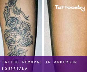 Tattoo Removal in Anderson (Louisiana)
