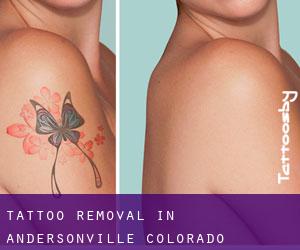 Tattoo Removal in Andersonville (Colorado)