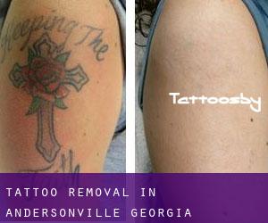 Tattoo Removal in Andersonville (Georgia)