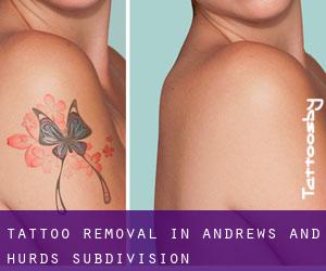 Tattoo Removal in Andrews and Hurds Subdivision