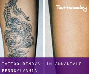 Tattoo Removal in Annandale (Pennsylvania)