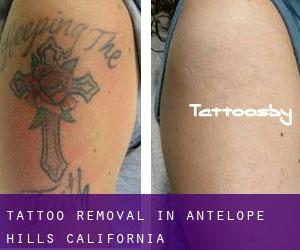 Tattoo Removal in Antelope Hills (California)
