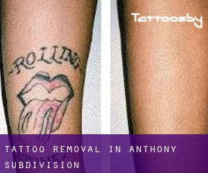 Tattoo Removal in Anthony Subdivision