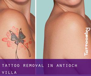 Tattoo Removal in Antioch Villa