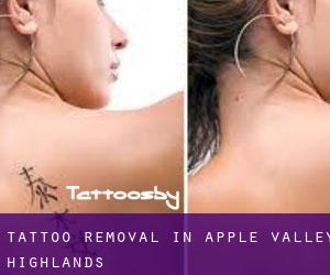 Tattoo Removal in Apple Valley Highlands