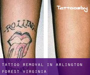 Tattoo Removal in Arlington Forest (Virginia)