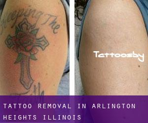 Tattoo Removal in Arlington Heights (Illinois)