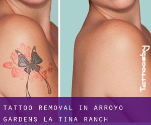 Tattoo Removal in Arroyo Gardens-La Tina Ranch