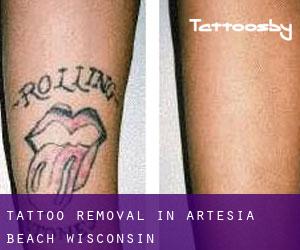 Tattoo Removal in Artesia Beach (Wisconsin)