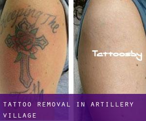 Tattoo Removal in Artillery Village